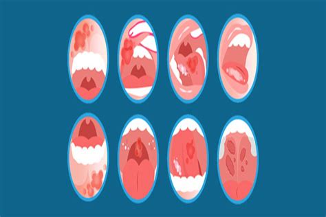 Oral Cancer: Causes, Symptoms & Treatment