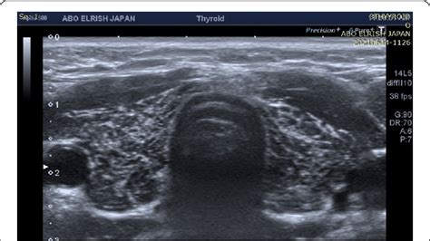 Thyroid Ultra Sound Of A 9 Years Female With History Of Neck Swelling