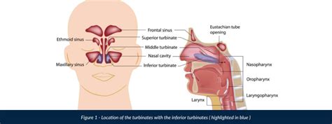 Inferior turbinate hypertrophy - Dr Gan Eng Cern