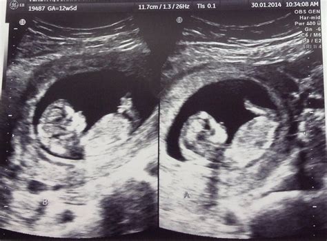 What Do Identical Twins Look Like On Ultrasound at Gloria Miller blog