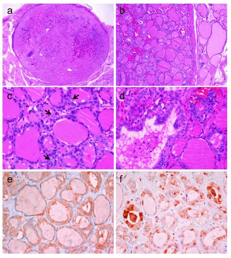 Noninvasive Encapsulated Classic Papillary Thyroid Carcinoma With