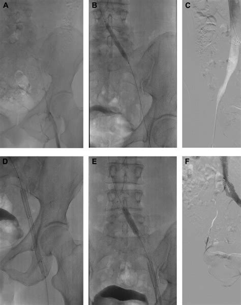 Endovascular Treatment For Iliofemoral Vein Thrombosis With Composite Stents Annals Of