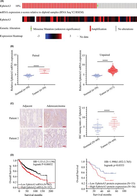 High Ephrina Expression Correlates With Poor Prognosis Of Luad