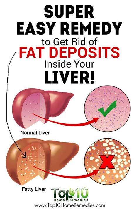 Home Remedies For Fatty Liver Disease Top 10 Home Remedies Liver Health Healthy Liver