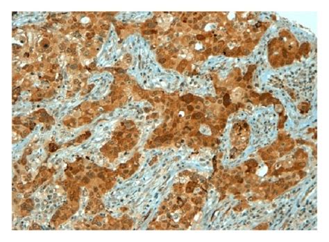 Representative Results Of Ihc Staining Of Nsclc Tumour Specimens For