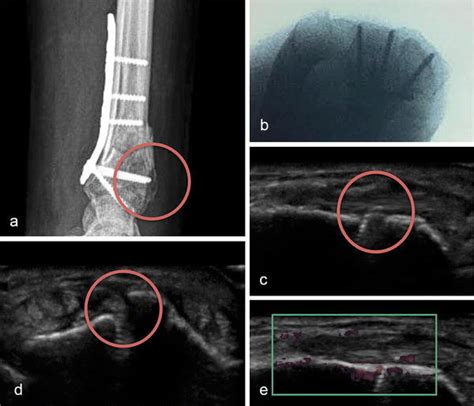 Imaging Of A Distal Radius Fracture Osteosynthesis By A Volar Locking Download Scientific