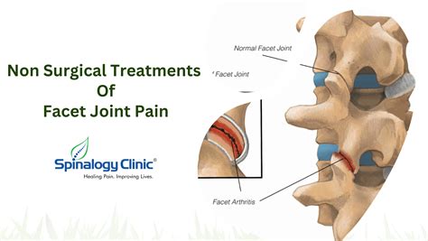 Facet Joint Pain Effective Non Surgical Treatments Blog Best Back