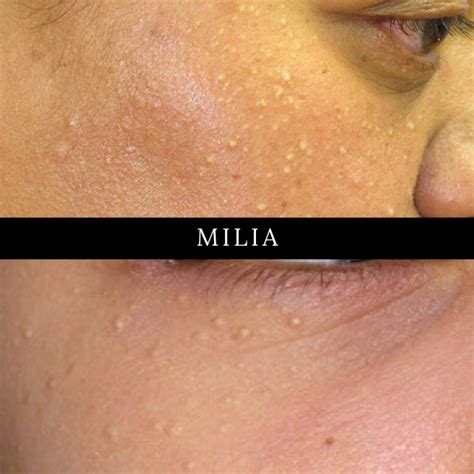 Skin Classic Treatment For Acne Milia And Blackheads