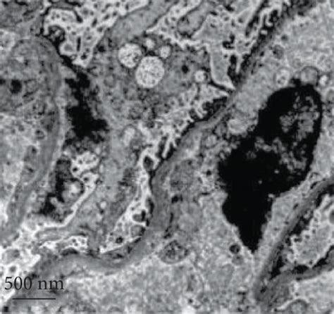 Effects Of Fk On Ultrastructural Variations Of Podocyte In Dn Rats