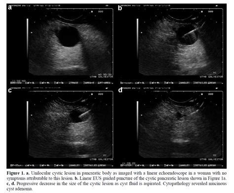 Role Of Endoscopic Ultrasonography In The Diagnosis And Treatment