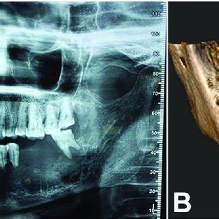 A Orthopantomograph Showing Ill Defined Radiolucency With Respect To