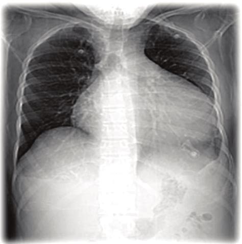 X Ray Of The Chest In Pa View Showing Increased Cardiac Silhouette And