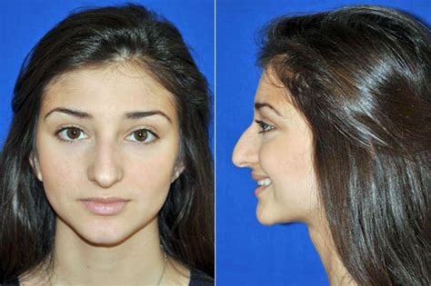 Ethnic Rhinoplasty Popular T For Persian New Year