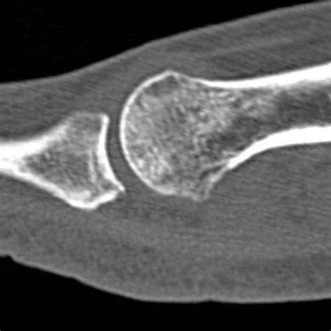 Sesamoid Fracture Image Radiopaedia Org