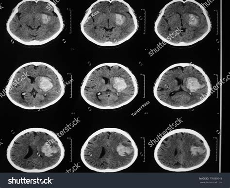 Стоковая фотография 776689948 Ctbrain Case Intraventricularl