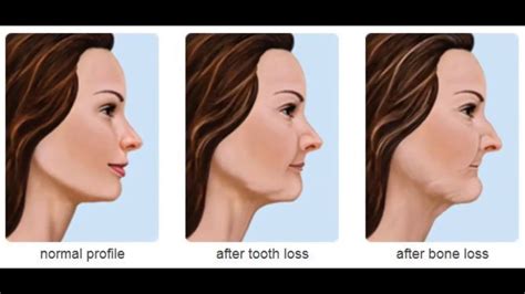 Missing Teeth Can Change Face Shape The Dental Arcade Blog