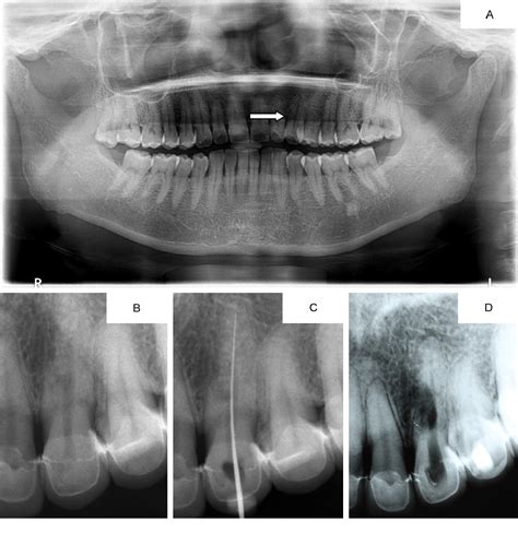 Figure From Three Year Follow Up Results For Non Surgical Root Canal