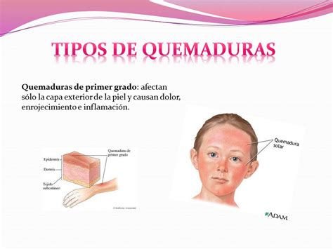 Primeros Auxilios Tipos De Quemaduras