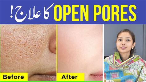 How To Treat Open Pores Open Pores Ka Ilaj Urdu Hindi Best Home