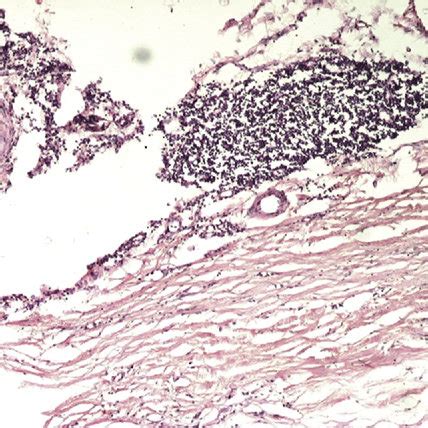 Histopathology slide showing syphilitic endarteritis obliterans.... | Download Scientific Diagram