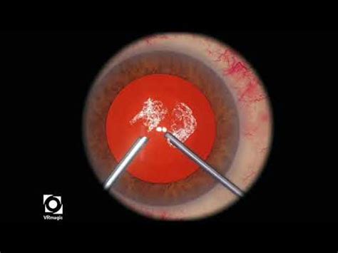 Eyesi Cat D Anterior Vitrectomy Level Youtube