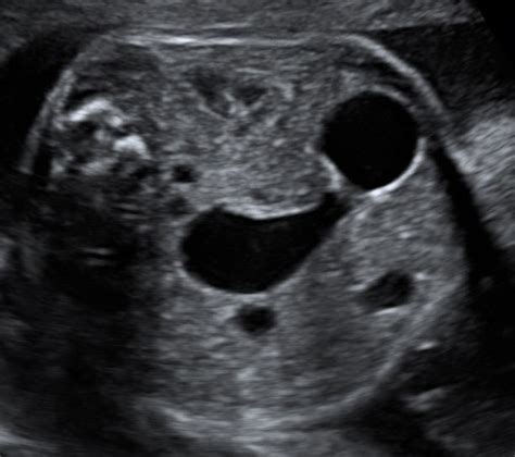 Duodenal Atresia Double Bubble Sign