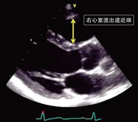 秒懂超声心动图的测量方法 好医术文章 好医术 赋能医生守护生命