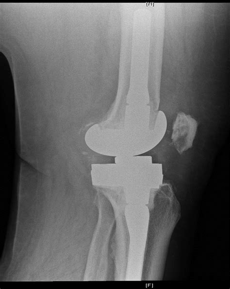 TKA Prosthesis Design - Recon - Orthobullets