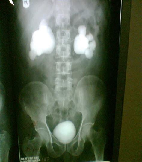 Showing The Percentage Of Puj Obstruction Due To Crossing Vessel And Download Scientific