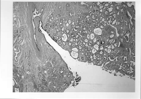 Histological Evaluation Of A Prostatectomy Specimen After Collecting