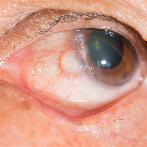 Conjunctival Retention Cyst