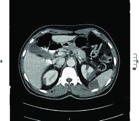 Splenic And Bilateral Renal Infarcts Download Scientific Diagram