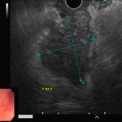 Endoscopic Ultrasound Demonstrating A 40 3 36 Mm Oval And Hypoechoic Download Scientific