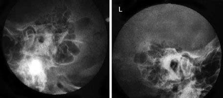 X Ray Mastoid Laws View