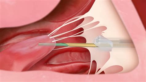 Transcatheter Mitral Valve Repair Medical Animation Youtube