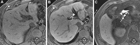 Multimodality Imaging Of Cholecystectomy Complications Radiographics