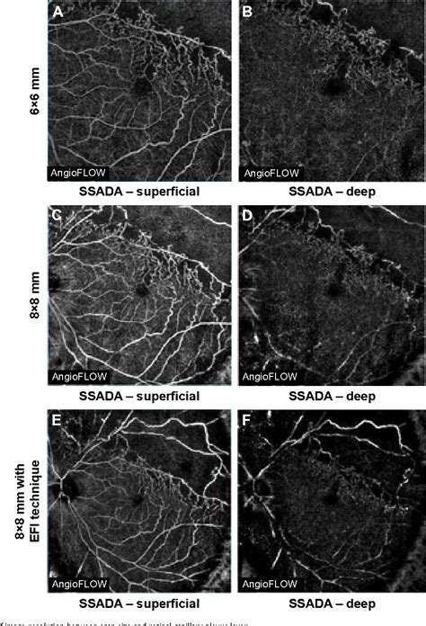 Figure 4 From Clinical Ophthalmology Dovepress Dovepress Wide Field