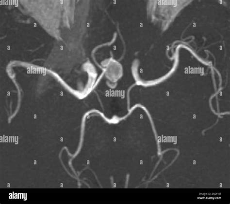 Cerebral Haemorrhage And Aneurysm Computed Tomography Ct Scan