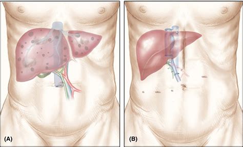 Laparoscopic Assisted Liver Transplantation A Realistic Perspective American Journal Of