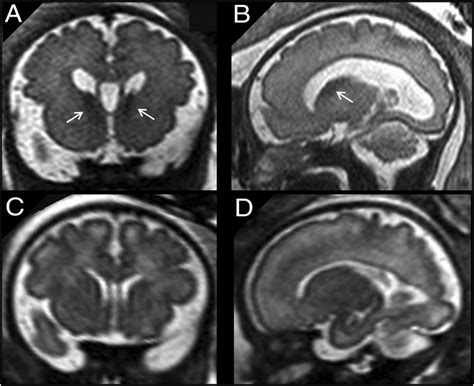 Ganglionic Eminence Anomalies And Coexisting Cerebral Developmental