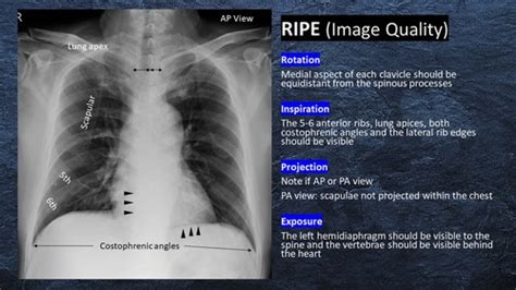 Chest X Rays Flashcards Quizlet