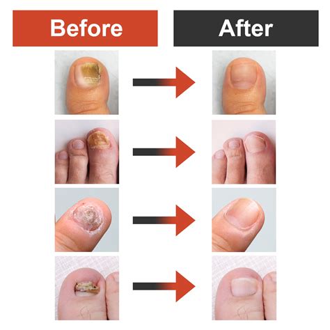 Severe Fungal Nail Treatment – Klipp Nail Care
