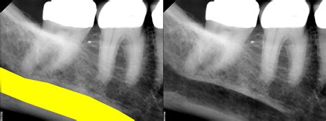 Anatomy Monday Anatomy On Mandibular Periapical Radiographs Dr G S