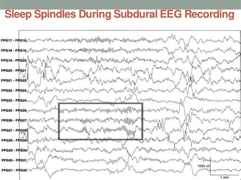 Sleep activity in eeg