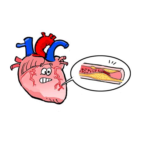 Infarctus Du Myocarde Lexique Sp Cialis Des Tudes Coll Giales En