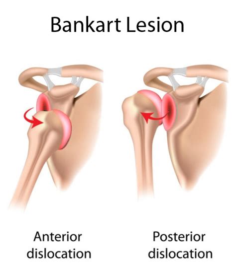 Bankart Lesion Bangalore | Shoulder Pain Symptoms