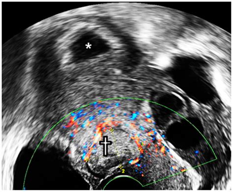 Successful Full Term Delivery Via Selective Ectopic Embryo Reduction