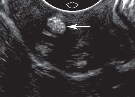 Cervical Lesions Ultrasound