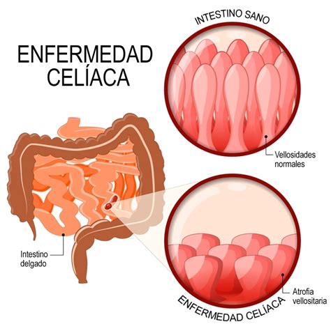 La Enfermedad Celíaca Acelu Org