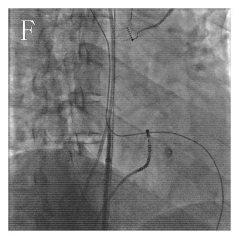 Transseptal Puncture With Fluoroscopy A At The Right Anterior